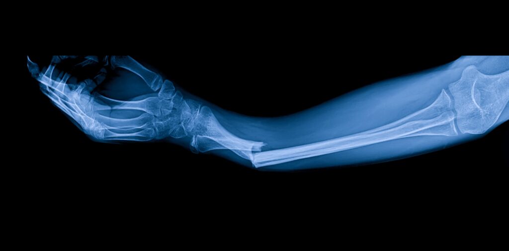 Our Expertise in Orthopedic Billing & Coding