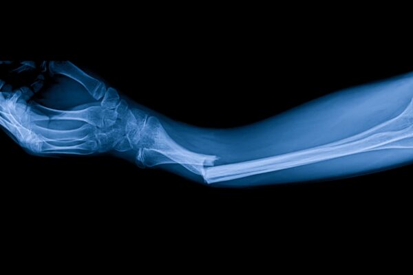 Our Expertise in Orthopedic Billing & Coding